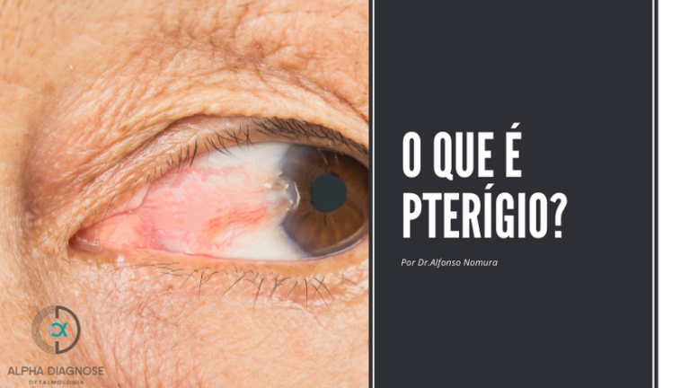 Pterígio no olho o que é causas e tratamentos Alpha Diagnose