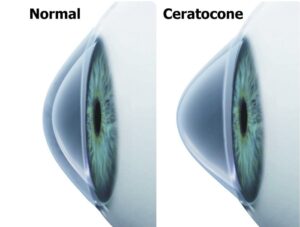 A córnea projeta-se para frente e sua forma aparenta um cone, dificultando a visão. (Foto: Arquivo pessoal)
