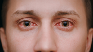 O que causa olhos vermelhos