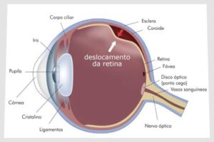 Descolamento de retina explicado em imagem gráfica