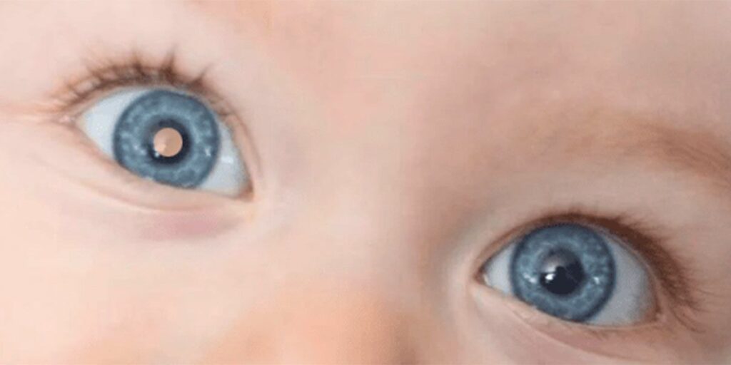 Retinoblastoma