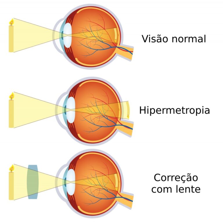 Qual a diferença entre presbiopia e hipermetropia? – Alpha Diagnose ...