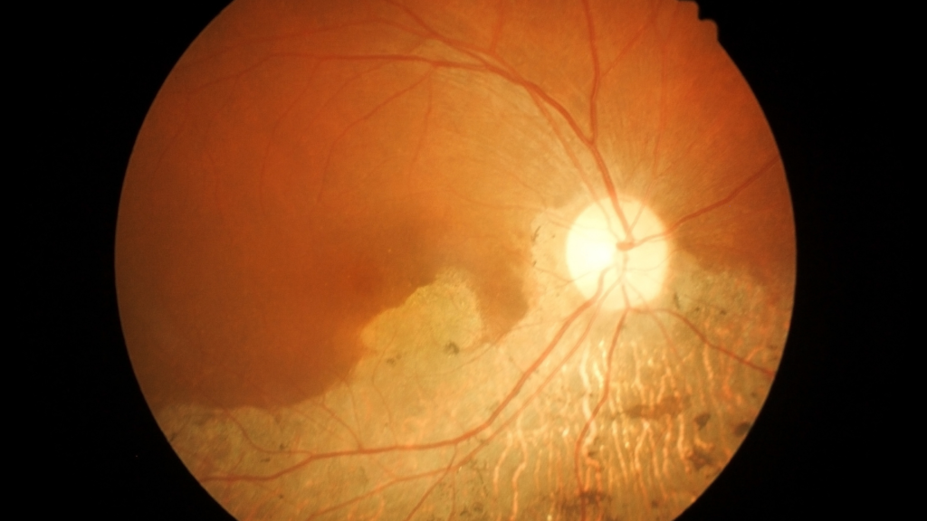 degeneração macular