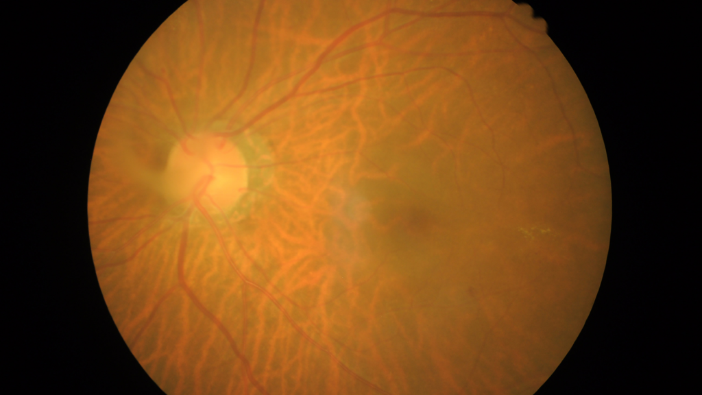 retina com retinopatia diabética