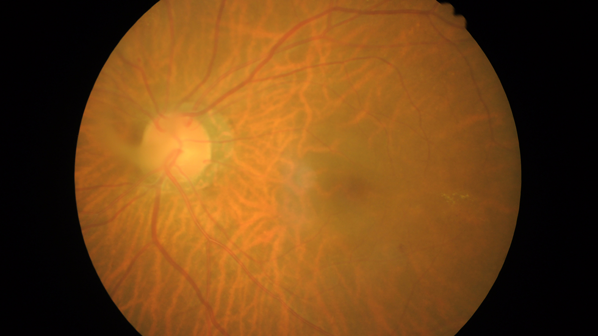 Retinopatia Diabética: O Que é, Causas E Tratamento - Alpha Diagnose ...