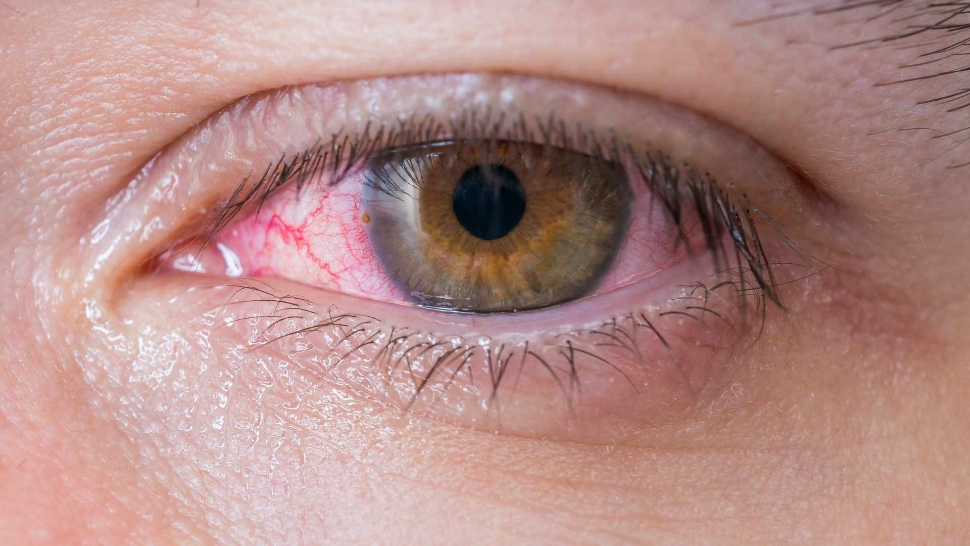 Inflamações Oculares: conheça os 3 tipos mais comuns